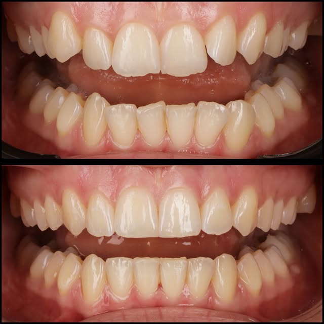 Invisalign result