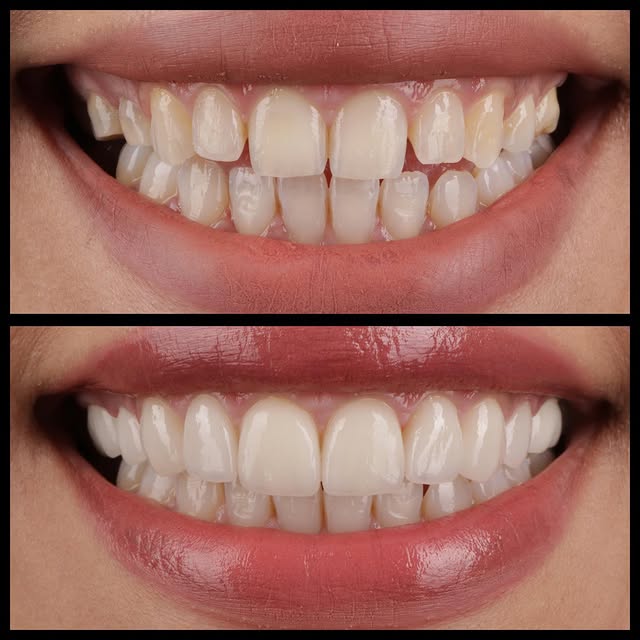 Before/After: Veneers + Gummy Smile correction