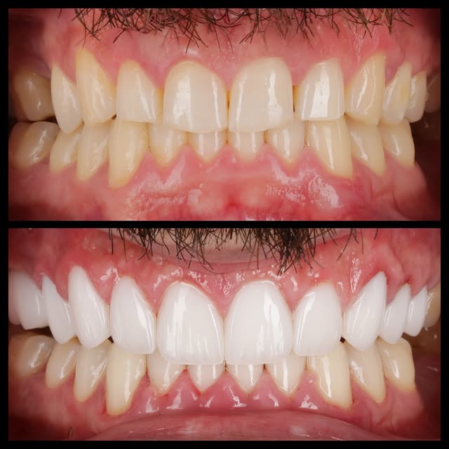 10 Veneers transformation